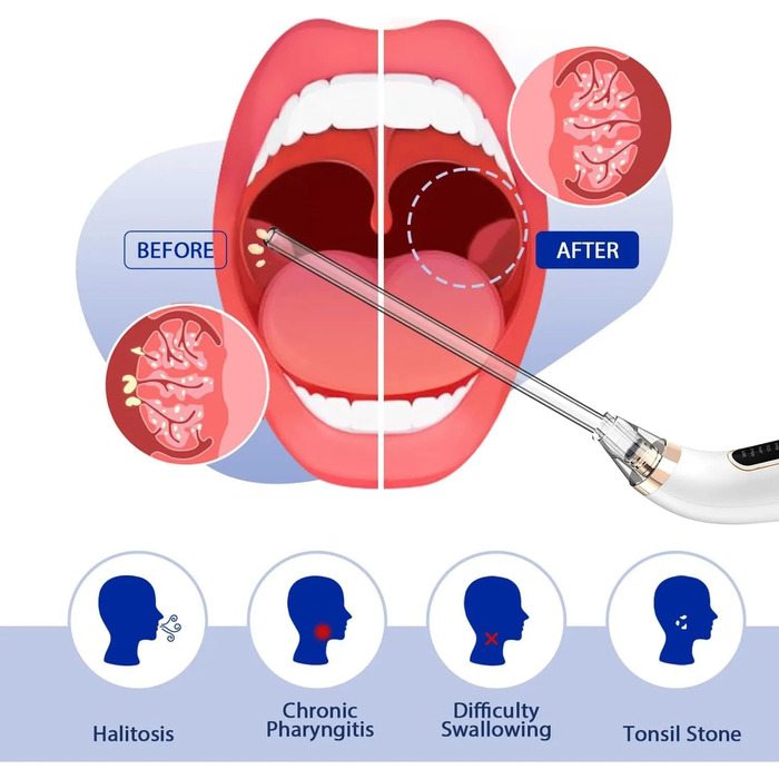 Електричний набір для видалення каменів мигдалин MiBrush - Вакуумна всмоктувальна піпетка, шприц для промивання, збільшувальне дзеркало та депресор язика - Швидко видаляє камені з мигдалин - Для здоров'я мигдалин і свіжого подиху.