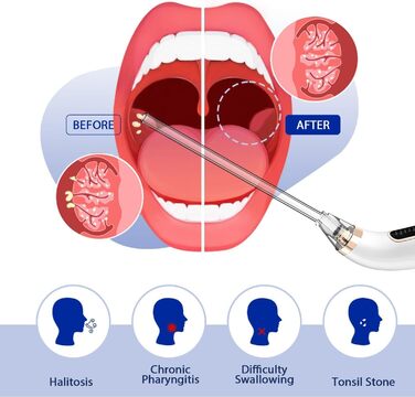 Електричний набір для видалення каменів мигдалин HaliQ - Вакуумна всмоктувальна піпетка - Повний набір для видалення каменів у мигдалинах - Свіжий подих - 5-кратне збільшувальне дзеркало, депресор язика та шприц