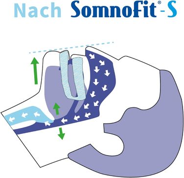 Стоппер від хропіння Somnofit-S - Шина проти хропіння (набір SomniShop з направляючою)