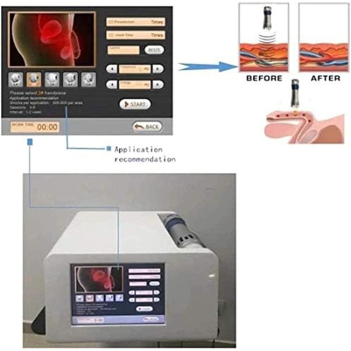 Пристрій для ударно-хвильової терапії ED, професійний ударно-хвильовий пристрій, пристрій для терапії ударною хвилею ED, міостимулятор, для терапії, полегшення болю, масажу, корекції фігури та лікування ED