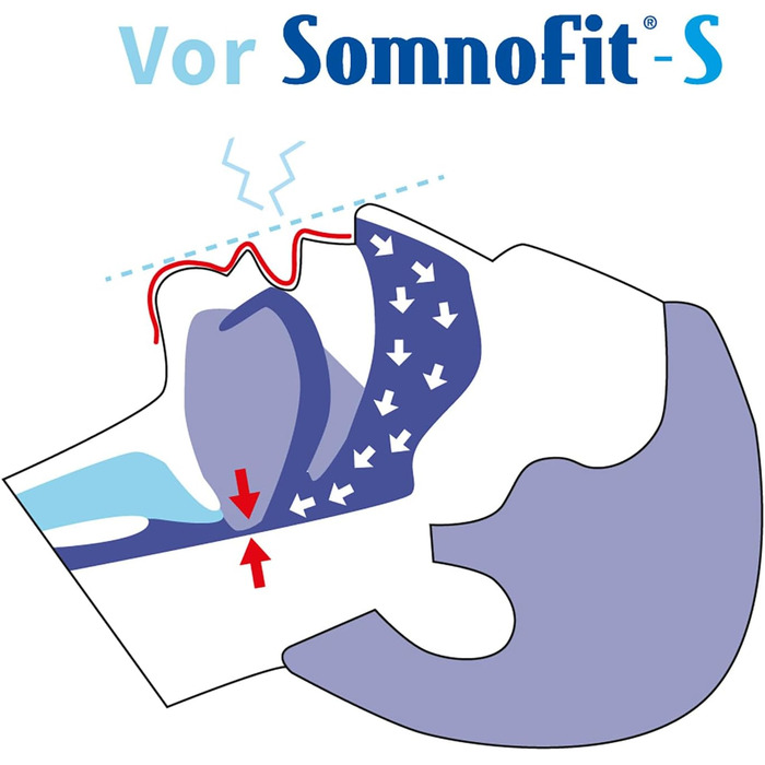 Стоппер від хропіння Somnofit-S - Шина проти хропіння (набір SomniShop з направляючою)